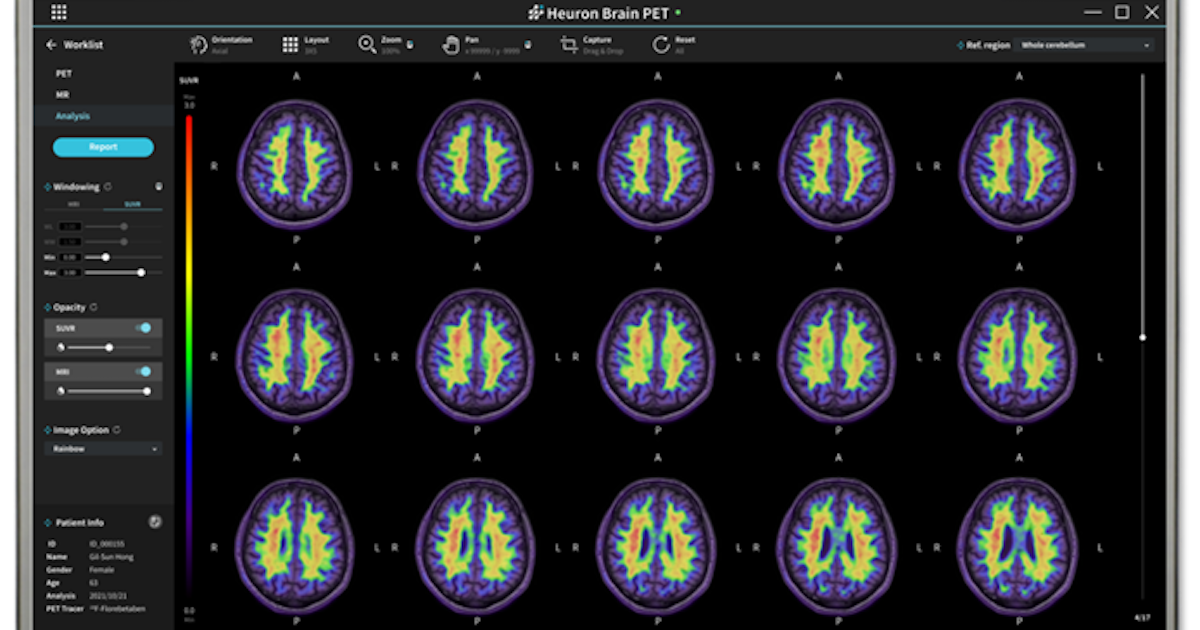 National University Hospital testing predictive AI for Alzheimer’s diagnosis and more AI briefs