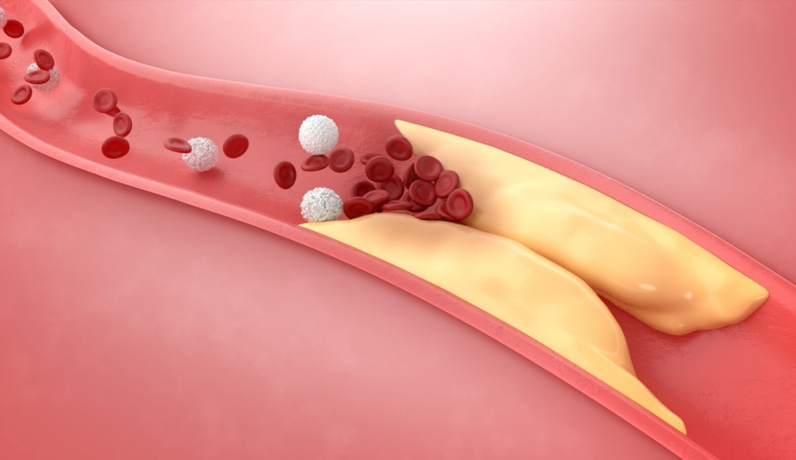 Dementia risk rises with elevated remnant cholesterol, South Korean study reveals