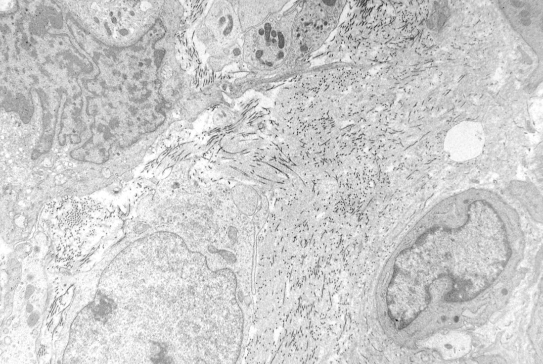 Adaptimmune’s FDA Approval Marks the First for an Engineered Cell Therapy for Solid Tumors